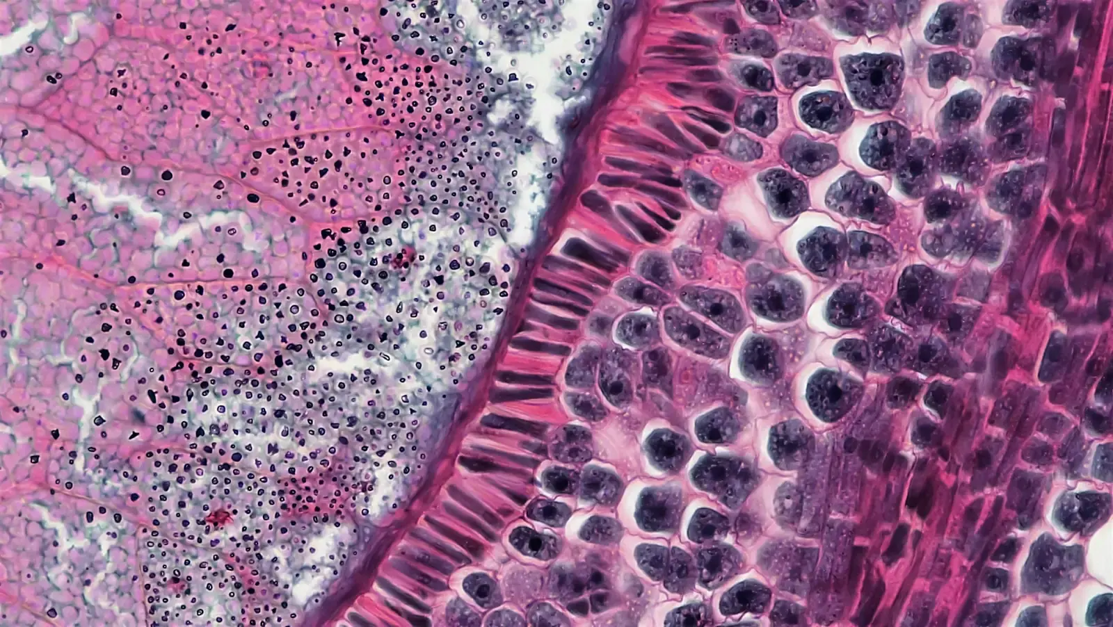 Trained a Gleason grading + tumor-segmentation model on full-resolution prostate WSI